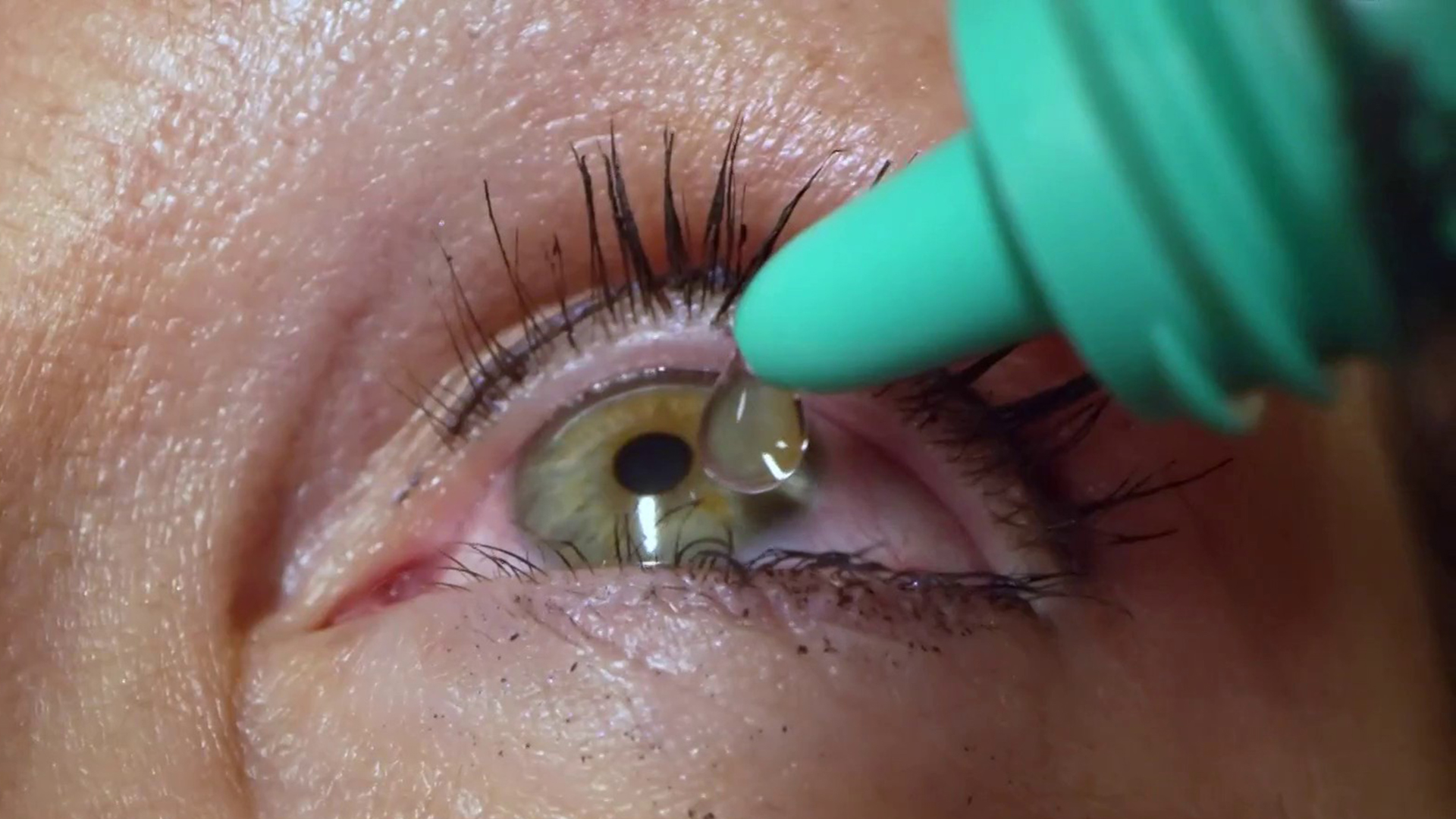 impuls Niet genoeg cowboy Woman Had 23 Contact Lenses Stuck Under Her Eyelid, Doctor Says